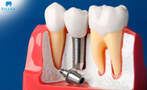 Titanium dental implants are considered safe, effective, and beneficial for overall oral health