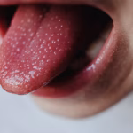 Why Are My Taste Buds Swollen? Causes & Treatment 2026