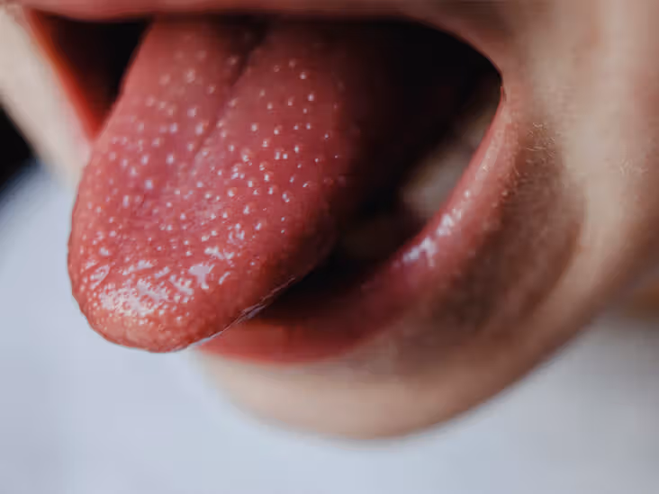 Why Are My Taste Buds Swollen? Causes & Treatment 2026
