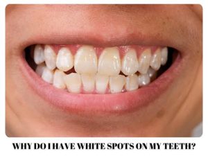 Why Are There White Spots on My Teeth? Causes & Fixes 2026