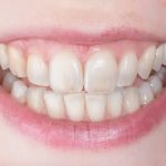 Why Are My Teeth Transparent? Signs of Enamel Loss 2026