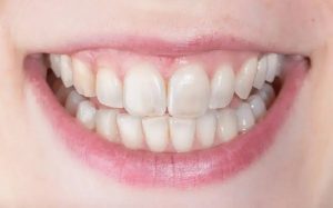 Why Are My Teeth Transparent? Signs of Enamel Loss 2026
