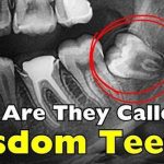 Why Are They Called Wisdom Teeth? History & Facts 2026