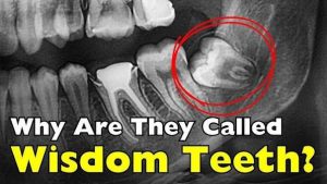 Why Are They Called Wisdom Teeth? History & Facts 2026