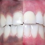Why Are My Gums Black? Treatment Options 2026