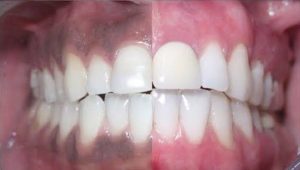 Why Are My Gums Black? Treatment Options 2026