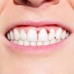 Why Do Gums Bleed? Causes, Prevention & Relief 2026