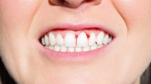 Why Do Gums Bleed? Causes, Prevention & Relief 2026