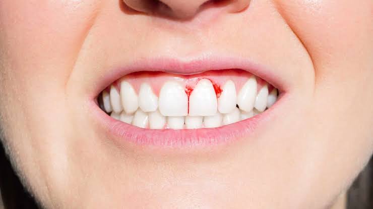 Why Do Gums Bleed? Causes, Prevention & Relief 2026