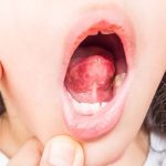 Why Is My Tongue Sore? Causes, Fixes & When to Worry 2026