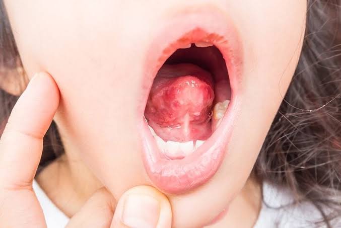 Why Is My Tongue Sore? Causes, Fixes & When to Worry 2026