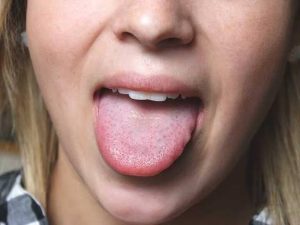 Why Is My Tongue Orange? Should You Worry? 2026