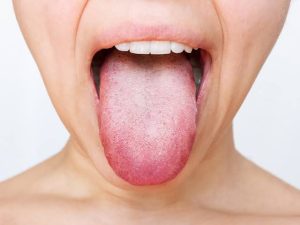 Why My Tongue White? Causes, Symptoms & Care 2026