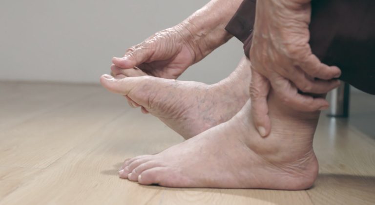Why Do My Ankles Swell? Signs You Shouldn't Ignore 2026