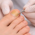 Why Is My Toenail Yellow? Signs of Fungus? 2026
