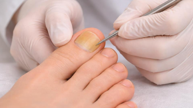 Why Is My Toenail Yellow? Signs of Fungus? 2026