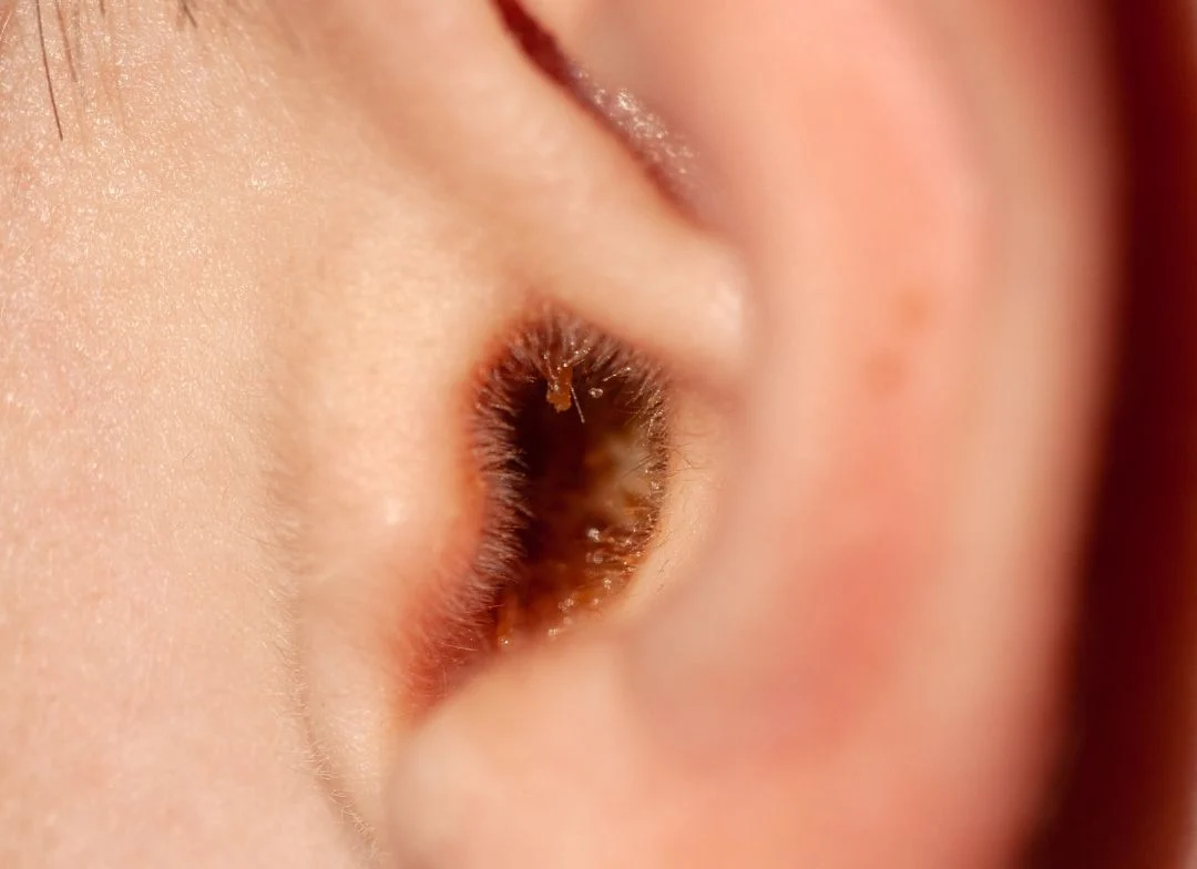 Why Is My Earwax Wet? Causes, Genetics & When to Worry 2026