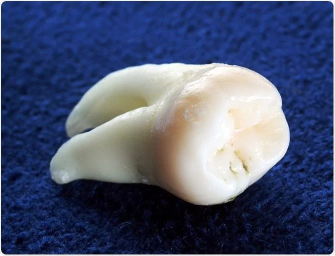Why Is It Called Wisdom Teeth? The Real Reason 2026