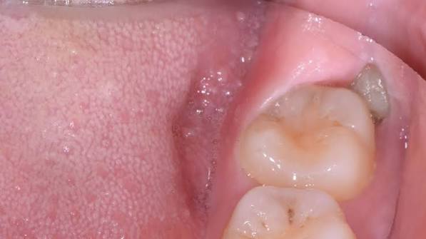 Why Do Wisdom Teeth Hurt? Causes, Signs & Fixes 2026