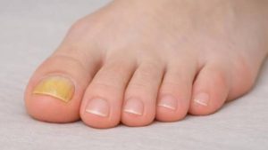 Why Do Toenails Turn Yellow? Signs & Treatment 2026