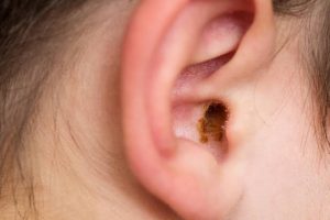 Why Do We Have Ear Wax? The Surprising Reason 2026