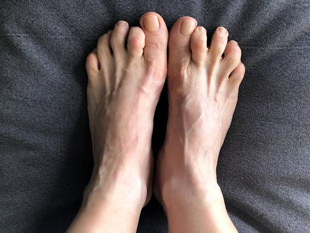 Why Is My Pinky Toe Sideways? Causes & Treatment 2026