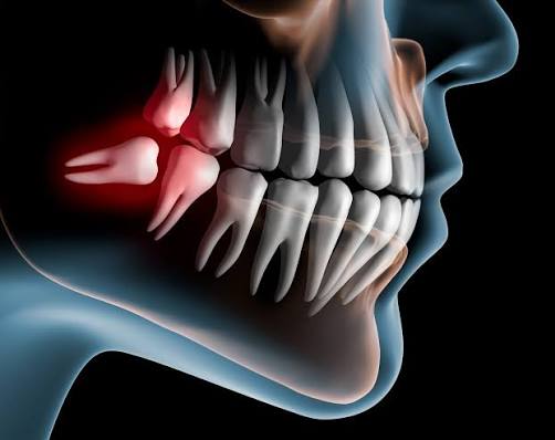 Why Do Wisdom Teeth Hurt? Causes, Signs & Fixes 2026