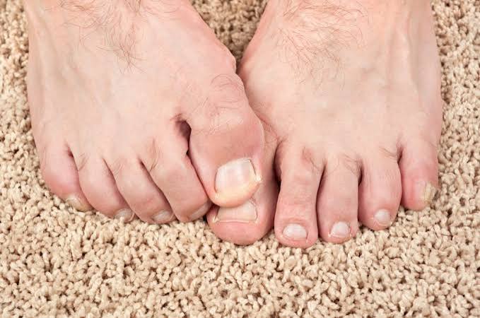Why Do Toenails Turn Yellow? Signs & Treatment 2026