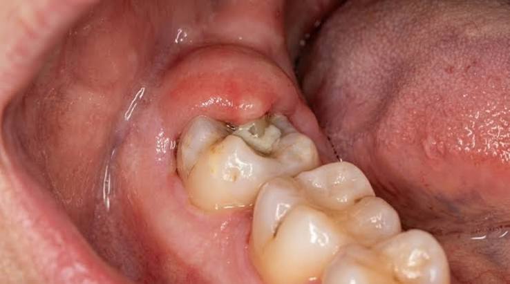 Why Do Wisdom Teeth Hurt? Causes, Signs & Fixes 2026