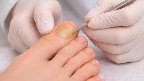 Why Do Toenails Turn Yellow? Signs & Treatment 2026