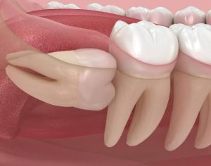 Why Do Wisdom Teeth Hurt? Causes, Signs & Fixes 2026
