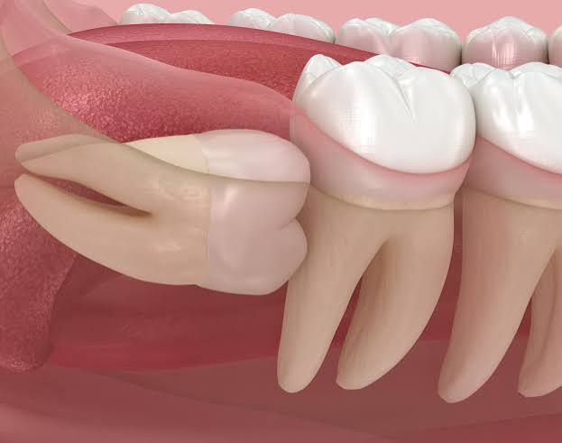 Why Do Wisdom Teeth Hurt? Causes, Signs & Fixes 2026