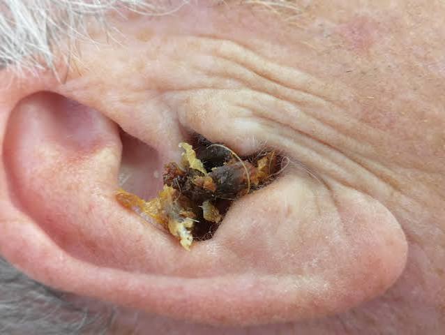 Why Do We Have Ear Wax? The Surprising Reason 2026