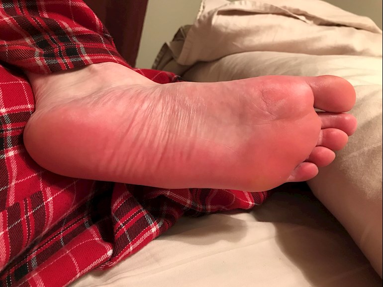 Why Are the Bottoms of My Feet Red? Causes Explained 2026