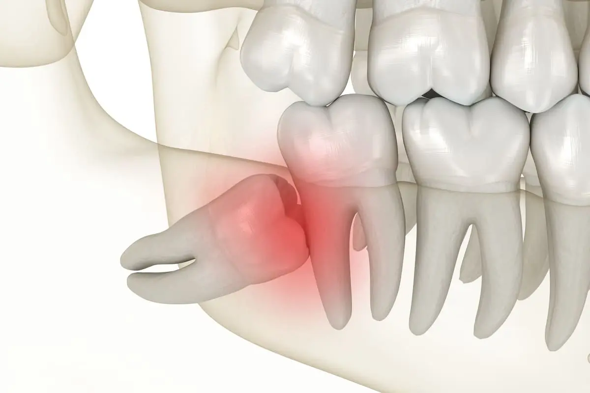 Why Is It Called Wisdom Teeth? The Real Reason 2026